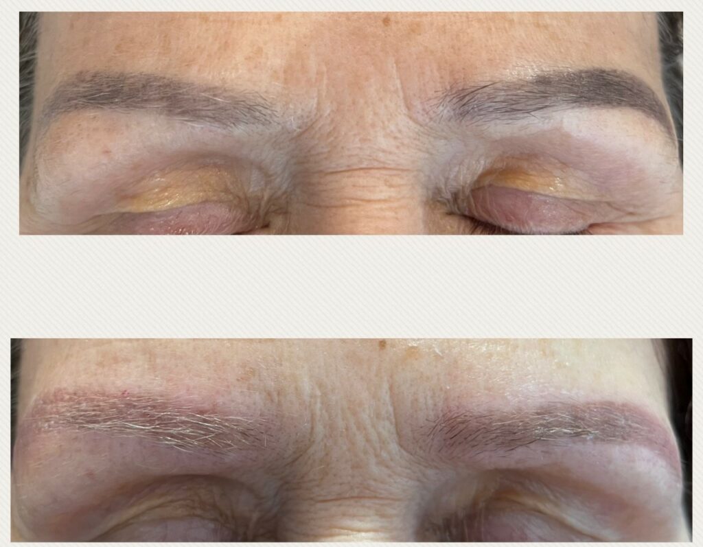 détatouage sourcils prix laser picoseconde dermatologue